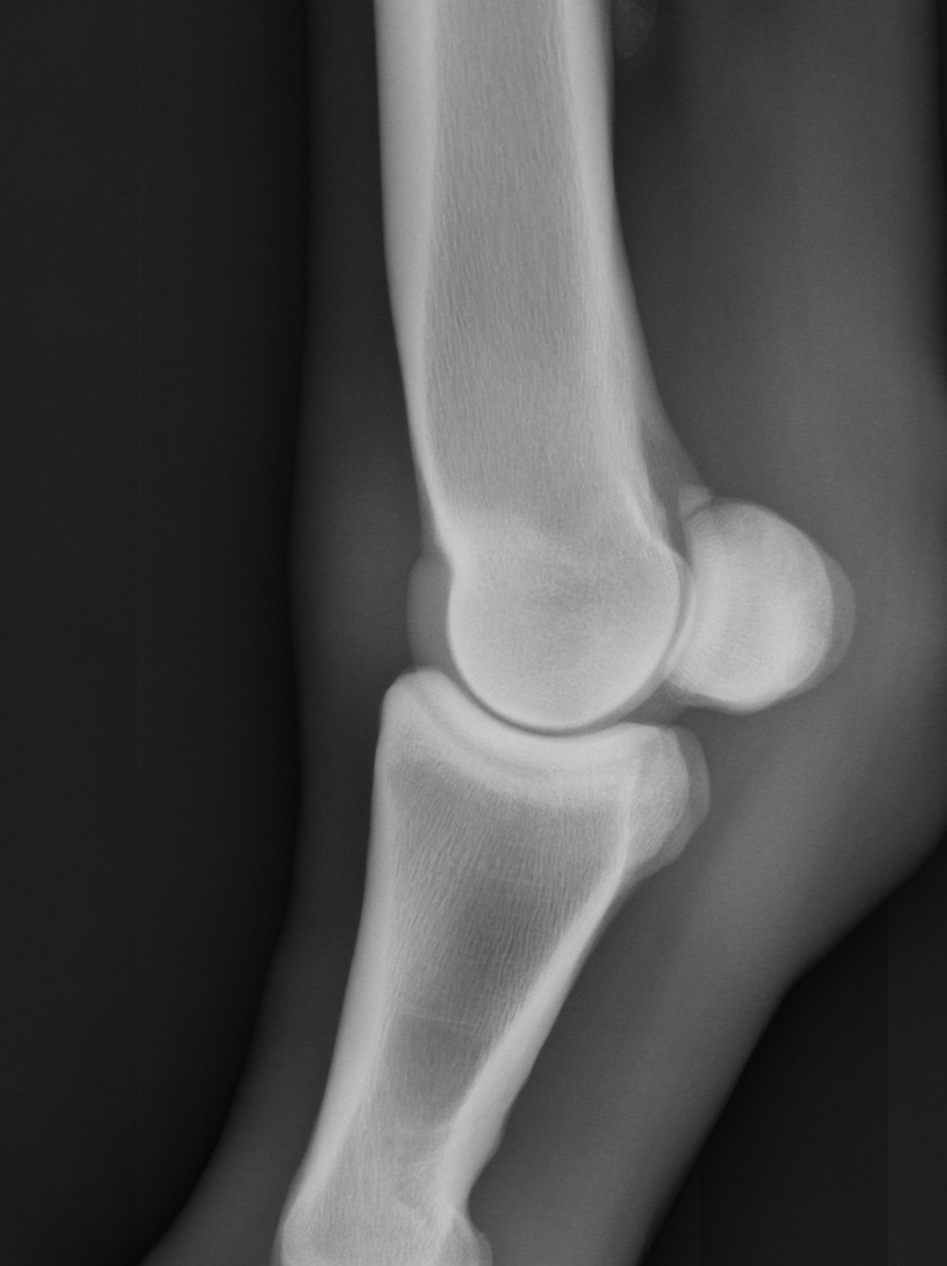 Understanding Sesamoid Fractures & Injuries In Horses